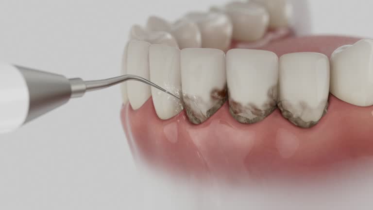 Trusted Dental Crowns And Bridges service in New Franklin, MO - Dentist Open Now